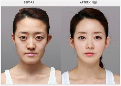 roi plastic surgery Korea